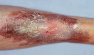 Diabetic Ulcers